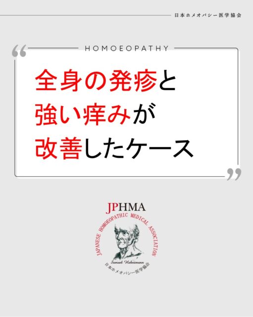本ケースは2025年に開催された第26回JPHMAコングレスへ片山里美ホメオパス（日本ホメオパシーセンター江別元町）より寄せられた「愛鷹明神水のレメディーを取入れて全身の発疹と痒みが改善した40代男性のケース」をまとめたものです。
詳細は「JPHMAコングレス」特設サイトhttps://cong.jphma.org/26th/26th-web_katayama-satomi-2/をご覧ください。

温泉に入った後に全身に広がり、眠れないほどの強い痒みに悩まされたクライアント。セルフケアでレメディーを試すも改善せず、皮膚科でも原因が分からないということで片山ホメオパスの相談会を受けられました。一時的な好転反応を乗り越え、霊性的成長が行われたことで症状は改善していきました。病気の原因は心身の問題だけでなく、時には魂の成長が必要であることを知らせるものでもあることが分かる貴重なケースでした。ぜひ同様の問題にお困りの方はZENホメオパシーを選択肢の一つとしてご検討ください。

#強い痒み #激しい痒み #発疹 　#原因不明の発疹 　#ホメオパシー #jphmaコングレス2025